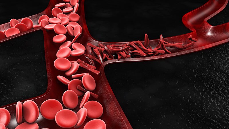 Sickle Cell CRISPR Therapy May Offer 'Functional Cure'