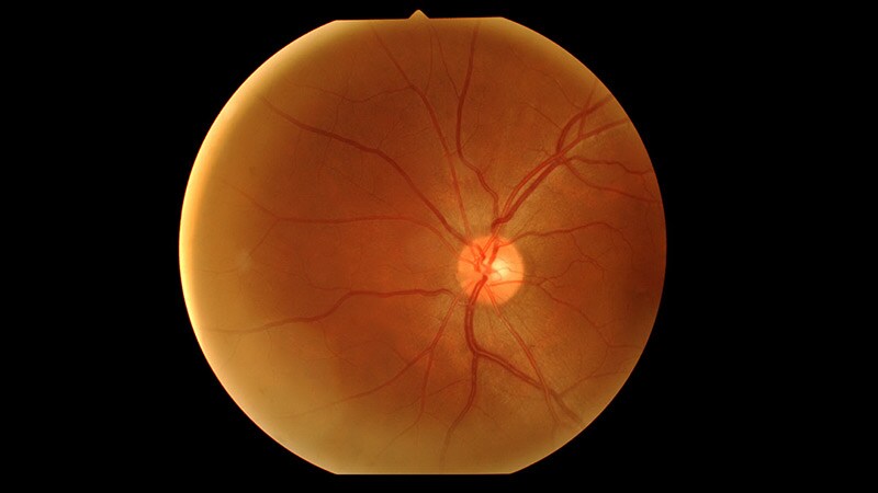Report: Kidney Disease Evident in These Eye Issues