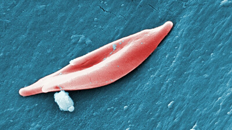 Sickle Cell Gene Therapy 'Truly Transformative'