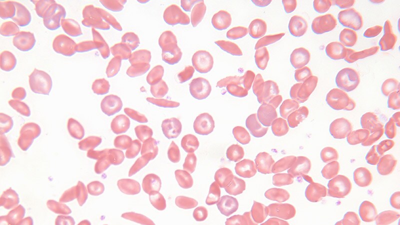 Sickle Cell: Good Outcomes for Haploidentical Transplants