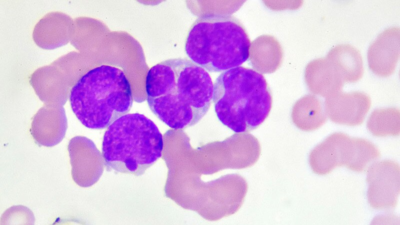 This Test May Guide AML Therapy for Black Pediatric Patients