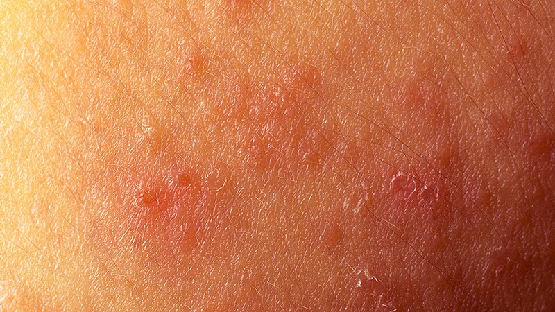 Experimental Topical Drug Shows Promise for AD, Psoriasis